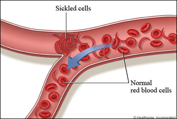 Figure 2. Normal versus sickle red blood cells in sickle cell disease. Sickled red blood cells can obstruct blood flow in small vessels, reducing oxygen delivery to tissues.
Adapted from HealthLink BC (2022).
