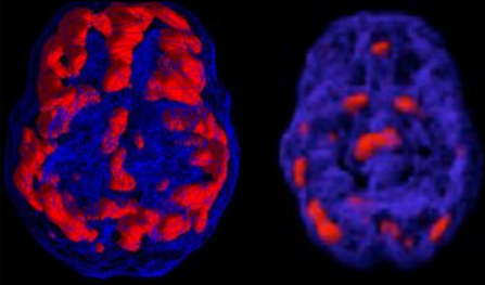 SPECT image of cortisol impact